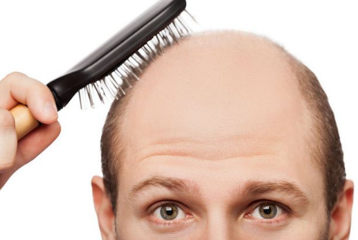 Nguyên nhân rụng tóc do di truyền