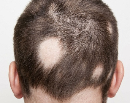 Rụng tóc từng mảng là bệnh gì?
