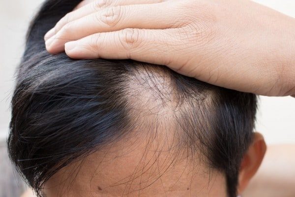 5 Cách điều trị hói đầu ở nam giới, kích thích tóc mọc trở lại