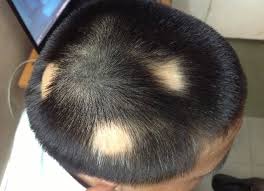 Nguyên nhân gây rụng tóc Pelade