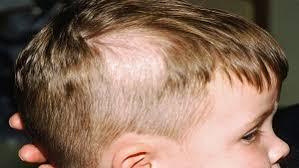 Chi tiết với hơn 164 về bệnh rụng tóc ở nam giới mới nhất