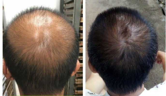 Phương pháp chống rụng tóc trị hói đầu cho nam giới