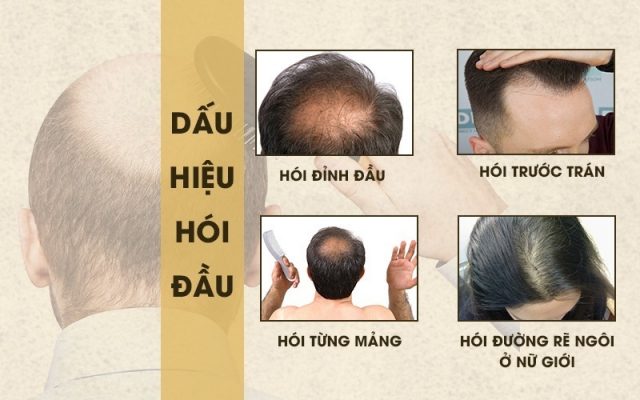 Dấu hiệu chứng tỏ tóc bạn có nguy cơ hói giải pháp khắc phục kịp thời đón  Tết rạng ngời